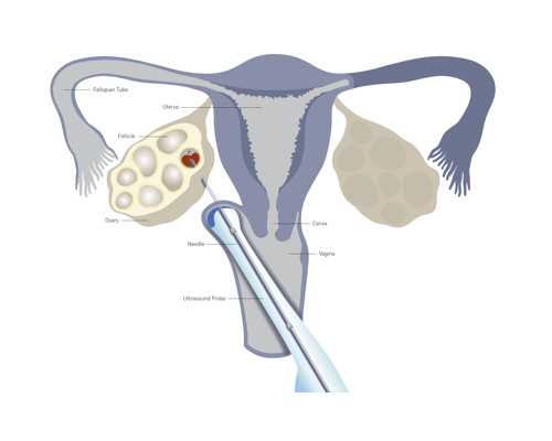 2022美国做单身试管婴儿要多少钱？附美国单身试管婴儿费用一览